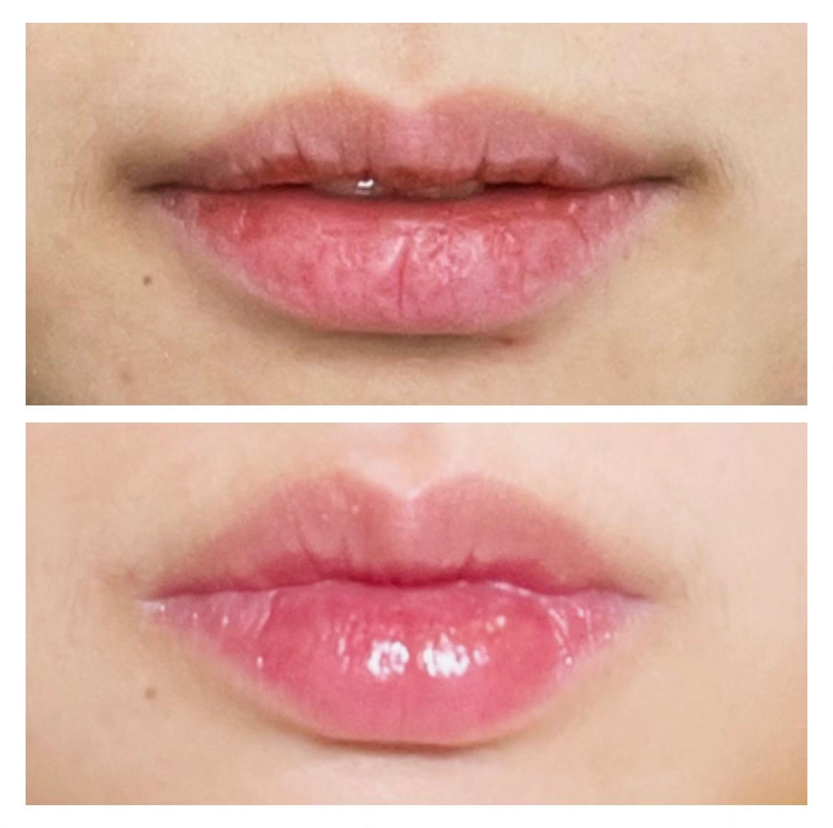 Dermal Filler, Facial Restoration & Balancing