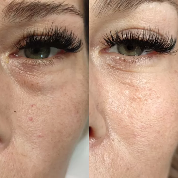 Eye area before and after treatment at Maison 58
