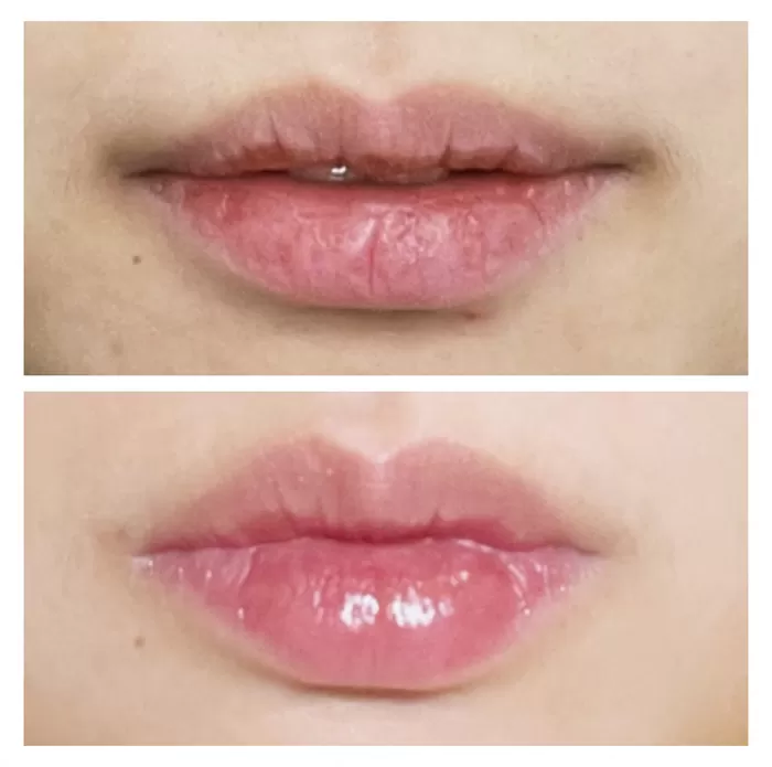 Lips before and after treatment at Maison 58