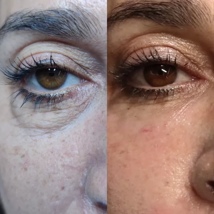 Skin around the eye before and after treatment at Maison 58