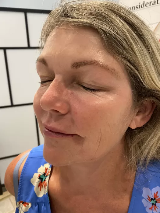 Skin after a medical-aesthetic treatment at Maison 58
