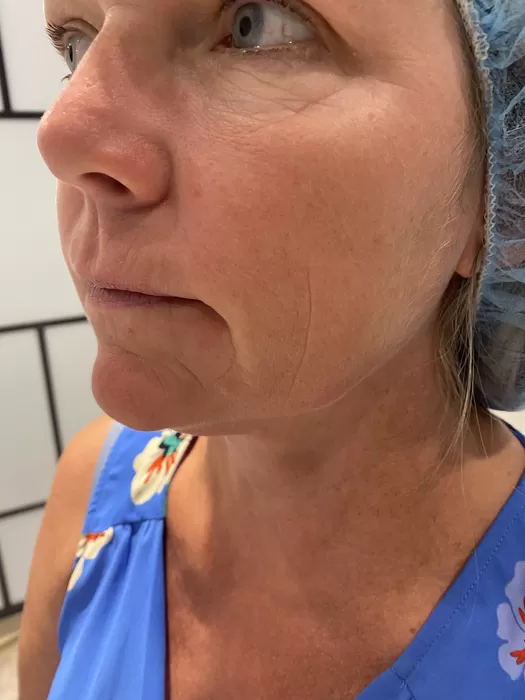 Skin quality in profile before treatment