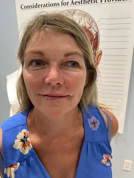 Skin after a medical-aesthetic skin treatment at Maison 58