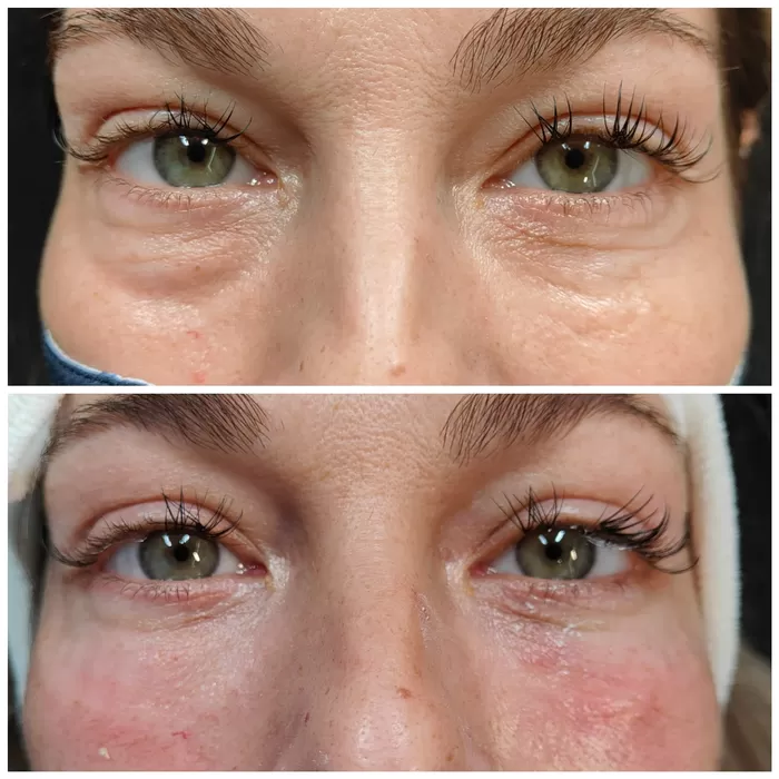 Under-eye area before and after treatment at Maison 58